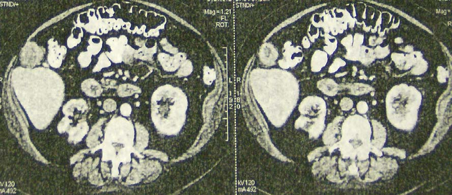Scanner abdomino-pelvien (Mars 2007) -une lésion tumorale tissulaire hétérogène,