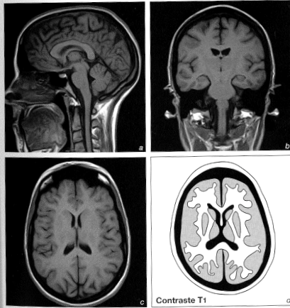 IRM anatomique Contraste T1 substance blanche blanche substance grise grise LCR (ventricules) noir Comprendre l IRM : Manuel d