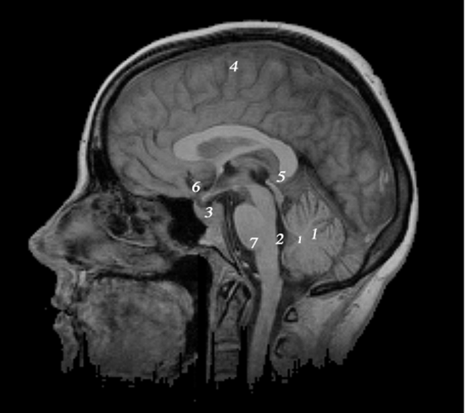 1 : cervelet (petit 1 : vermis) 2 : 4 e ventricule 3 : selle turcique 4 : hémisphère cérébral 5 : glande pinéale 6 : chiasma optique 7 : tronc cérébral Figure.