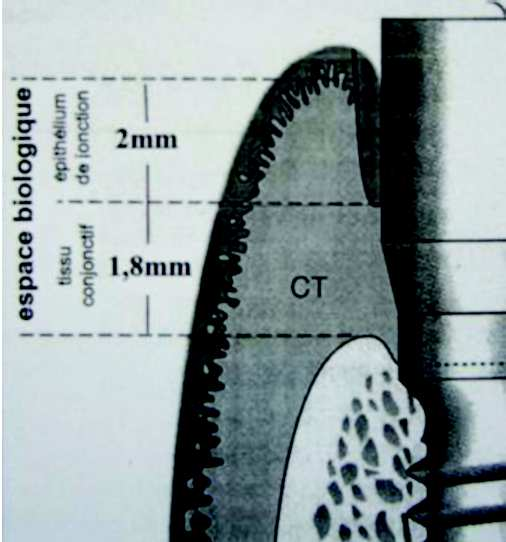 (2,14 contre 2,05 mm), c est surtout l attache conjonctive péri-implantaire qui voit sa longueur augmenter (1,66 contre 1,12 mm).