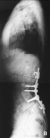 Séquelles de la radiothérapie Les corps vertébraux se développent au moyen d une ossification enchondrale, de la même manière que les épiphyses des os longs.