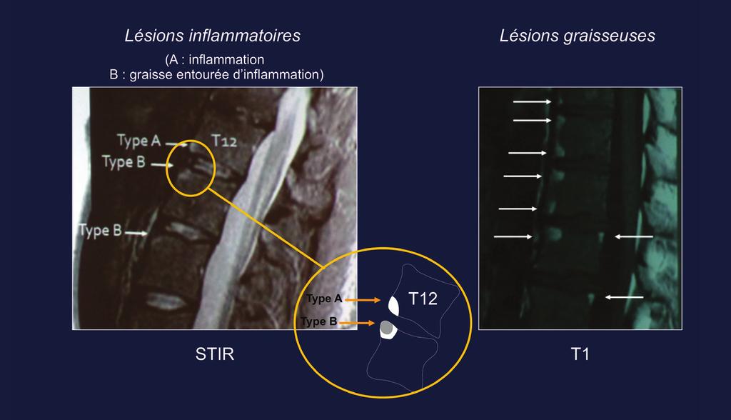 Figure 8. Lésions inflammatoires IRM du rachis : Les lésions graisseuses correspondent à un hypersignal en séquence T1.