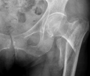 Exemple d une fracture cervicale Garden II Selon la position du trait de fracture par rapport au massif trochantérien on en distingue plusieurs types : principalement fracture pertrochantérienne (la