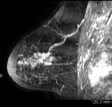 Aspects Radiologiques des cancers du sein chez les femmes BRCA1:IRM Rehaussment non masse