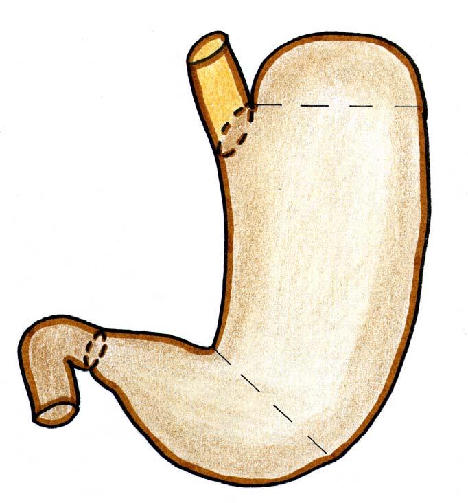 Incisure cardiale ( angle de His) Fundus Cardia T 11 Petite courbure Incisure