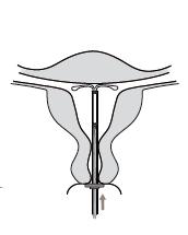 Figure 5 : Déploiement des ailes de KYLEENA Étape 6 Atteinte de la position fundique Pousser délicatement le dispositif d insertion vers le fond de l utérus jusqu à ce que la bague touche le col de l