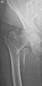 Fractures pertrochantériennes Dan Putineanu NFORMATIONS CLEFS IIMAGE CLEF Les fractures pertrochanteriennes sont les fractures le plus fréquemment opérées, avec le taux de mortalité postopératoire le