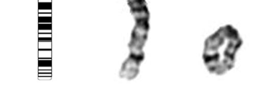 d. Chromosome en anneau ( r ) Implique un chromosome Cassure sur chacun des deux bras,