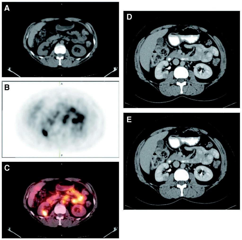 Divgi et coll Fig. 2. Patient présentant une tumeur à cellules claires de 1,0 cm à droite.