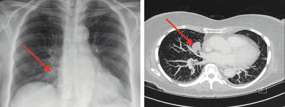 ARTICLE DE REVUE 294 A B Figure 1: Radiographie conventionnelle (A) et tomodensitométrie thoracique (B) de la patiente de 70 ans.