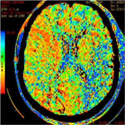 Scanner cérébral de perfusion