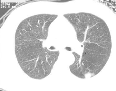 Extension métastatique : M Extension métastatique pulmonaire - Même difficultés diagnostiques que pour la