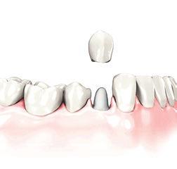 Solutions pour restaurer une dent abîmée Couronne dentaire Les dents ébréchées ou fissurées doivent absolument être soignées.