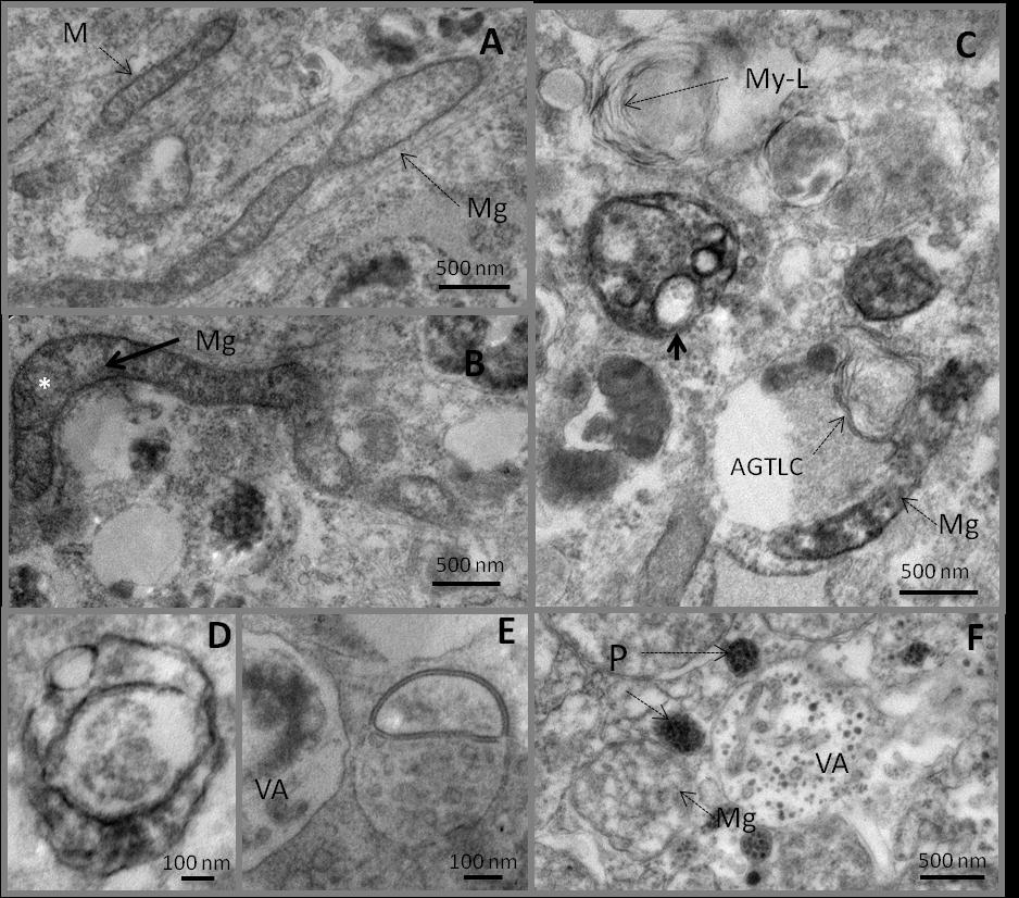 ACOX1 et Fonctions mitochondriales Résultats-Chapitre IV Figure 36. Micrographies électroniques de fibroblastes issus de patients P-NALD (P3 et P5).
