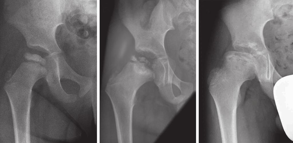 Le reste de l examen est normal ainsi que les radiographies du bassin de face et des deux hanches de profil (Lauenstein), permettant ainsi d éliminer une lésion osseuse.
