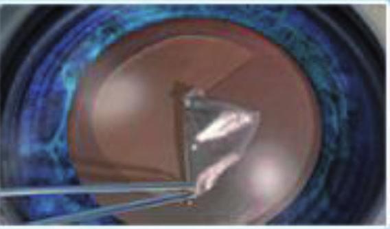 Chirurgie de la cataracte conventionnelle L œil est endormi au moyen de gouttes anesthésiantes, rendant l opération indolore.