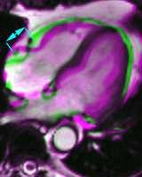 12 Tracé endocardique manuel du VD (diastole en haut, systole en bas) chez un patient atteint d un infarctus du VD, dont la coupe la plus basse (coupe numéro 1, à gauche) pose problème au contourage