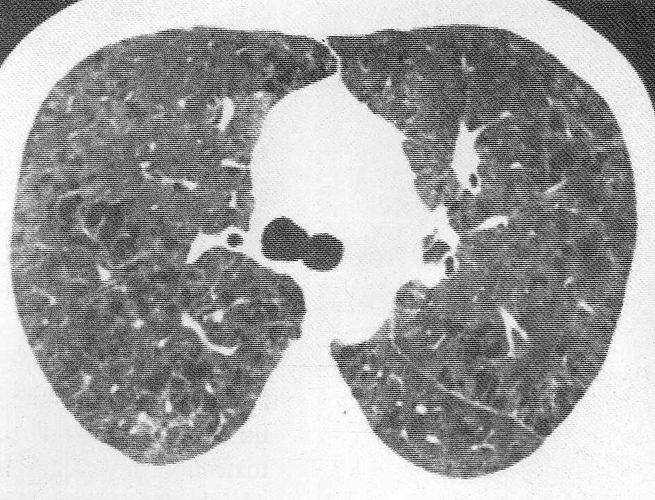 e Lésions du parenchyme pulmonaire : Lésions d emphysème au centre de l
