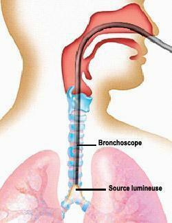 Au cours de l'examen il est possible de prélever un peu de tissu bronchique à l'aide d'une petite pince introduite dans le canal du fribroscope ; cela s'appelle une biopsie, ce n'est pas un acte
