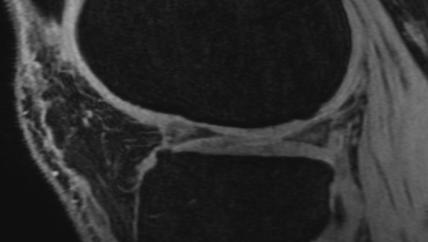 Cartilage : 3D écho de gradient Inconvénients Temps d acquisition long