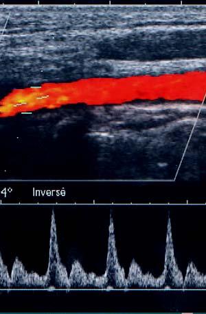 DOPPLER VASCULAIRE Informations hémodynamiques +++ : perméabilité vasculaire sens