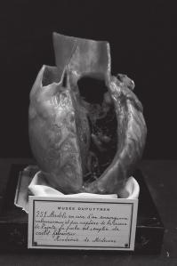 Anévrysme de la crosse de l'aorte Pour pouvoir conserver des pièces anatomiques ou tout du moins leur image, deux pistes s ouvraient : soit la conservation en fluide, soit, plus précise et plus belle