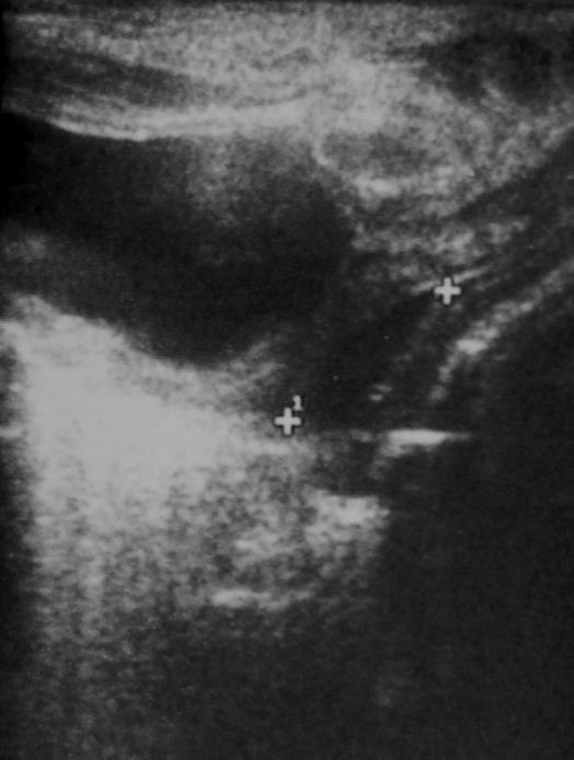Une échographie a été pratiquée chez cet enfant: Coupe sagittale au niveau du pelvis: