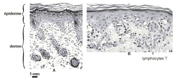 Document 2 : Aspect de la peau à la suite d'une greffe Coupes histologiques de peau de souris - à gauche : peau "normale" in situ - à droite : fragment de peau