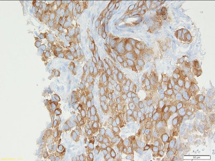 Matériels et méthodes absent, les cellules tumorales conservent une coloration bleutée par rapport au témoin positif qui sera marron.