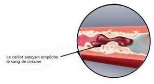 la fibrinolyse Permet l élimination du caillot de fibrine Enzyme clé = la plasmine Très active Présente dans le sang sous