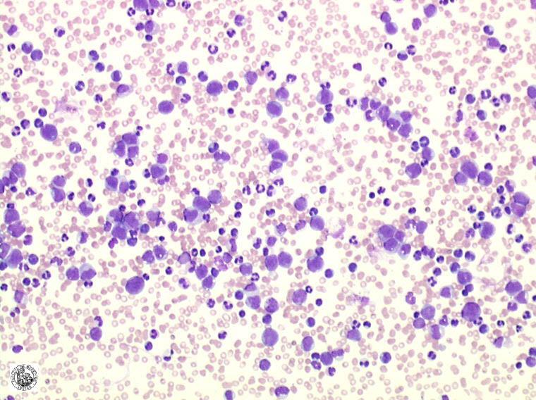Dossier 2016-4/B: Leucémie aiguë myélomonocytaire (LAM4 FAB) Données clinico-biologiques: Femme de 66 ans.