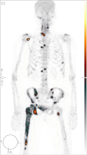 Modes d acquisitiond Tomographie d émission monophotonique (3D) Single photon emission computed tomography (SPECT) permet d obtenir des coupes de la région étudiée (3D) permet