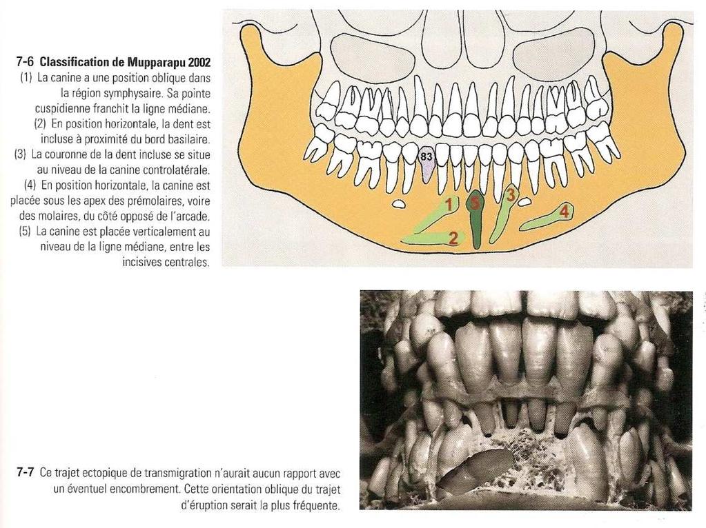 Eruption dentaire définitive mandibule Canine mandibulaire Crypte osseuse sur la corticale du rebord basilaire Éruption habituelle dans un sens vertical