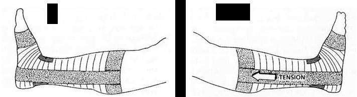 > Strapping de la cheville Mise en place de 2 étriers verticaux en élastoplaste de 6 cm de largeur : - Le premier étrier est appliqué à la face interne de la jambe, depuis l'ancrage supérieur,