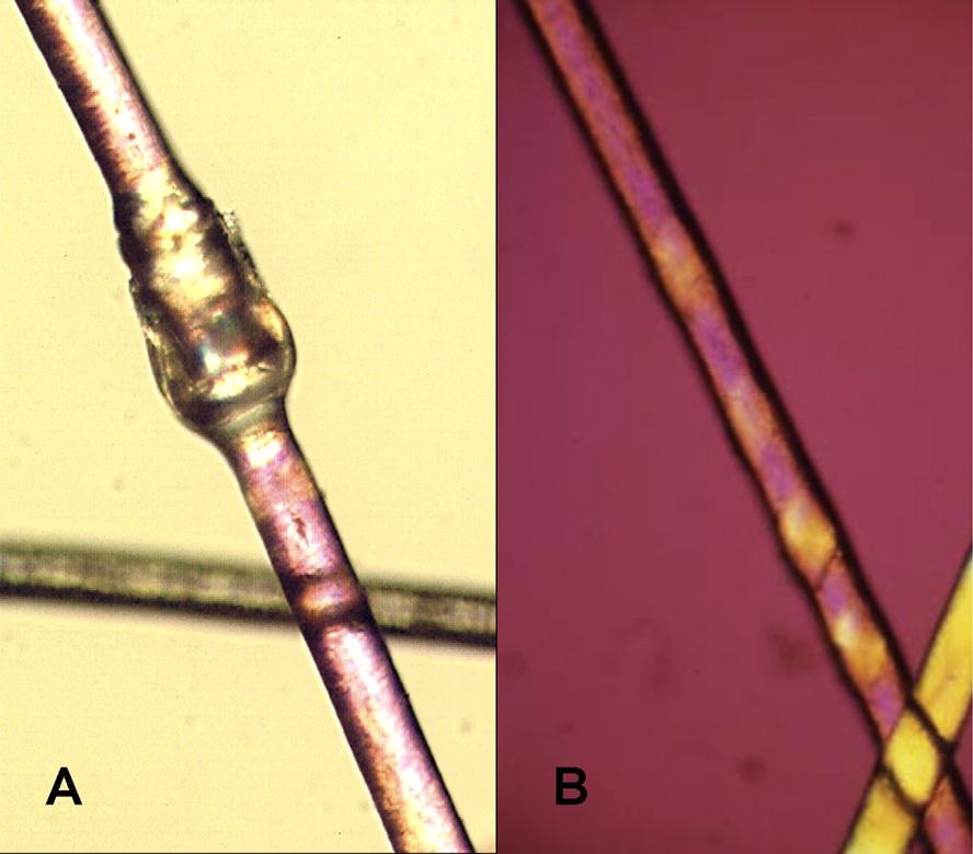 Poussées inflammatoires eczématiformes des plis. C. Ichtyose linéaire circonflexe. D. Alopécie faite de cheveux cassés courts. Figure 4.