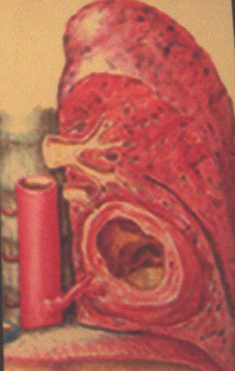 SEL kystique: vascularisation artérielle: