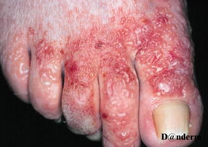 érythématosquameuses ; l acné commune est polymorphe et associe des papules, des pustules et des microkystes fermés ou ouverts (comédons)