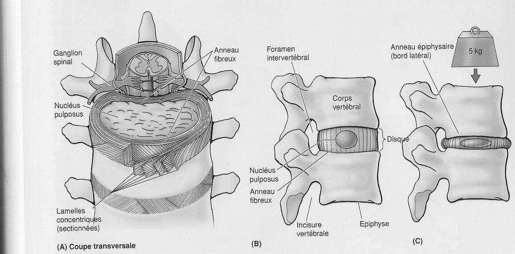 Structure du disque intervertébrale Hernie discale Disque lésé niveau colonne
