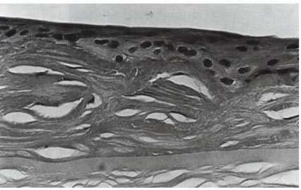 Dystrophie de Reis-Bückler Histopatho: Membrane subépithéliale contenant Bowman, fibroblastes et tissu fibreux: se
