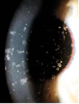 Dystrophie granulaire Opacités blanc-grises, bien délimitées dans stroma antérieur stroma