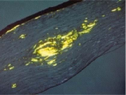 Dystrophie en lattice Histo: Dépôts d amyloïde dans stroma: Biréfringence Rouge Congo