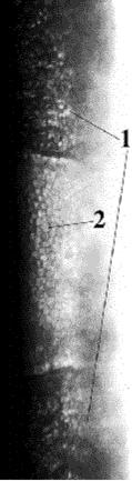 Dystrophie polymorphe postérieure Vésicules: Isolées ou en groupe Petites excavations ou ampoules sur Descemet, limites