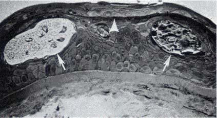 Dystrophie de la membrane basale Dots Pseudo-kystes contenant