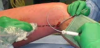 chirurgie) Bloc opératoire Anesthésie Bloc saphène (sensitif) >> LCA et PTG Contrôle échographique Naropin 100mg
