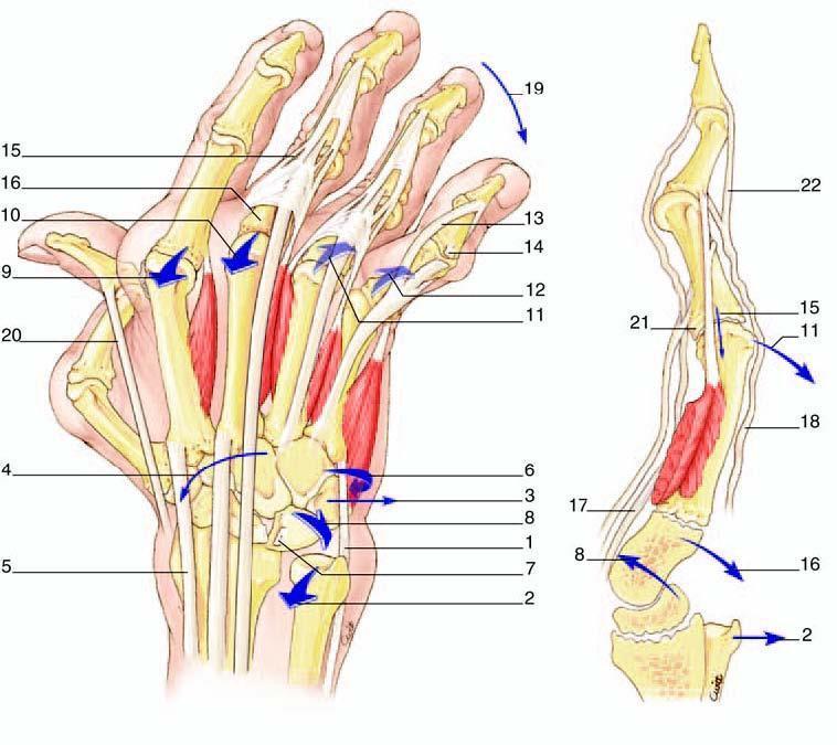 Déformations au niveau du poignet de la main et des doigts. a. Au niveau du poignet : Elles sont liées aux distensions ligamentaires provoquées par la synovite articulaire.