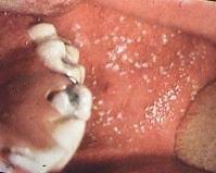 Rougeole classique Infection due à Morbillivirus Contagiosité +++ Transmission aérienne de personne