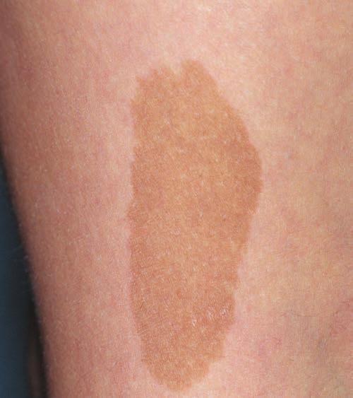 Sémiologie dermatologique Macules pigmentaires Elles sont dues à une accumulation de pigment dans l épiderme ou dans le derme. Il s agit le plus souvent de mélanine, pigment naturel de l épiderme.