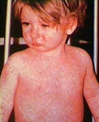 La rougeole Thérapeute Maladie éruptive de l enfant Contagieuse Nombreuses complications