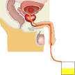 Sondage urinaire à demeure Le sondage urinaire à demeure = introduction d une sonde stérile dans la vessie par l urètre.