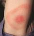 Maladie de Lyme chez l enfant (ML)